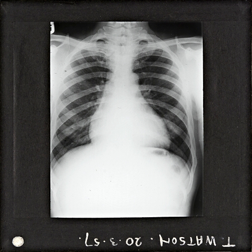 X-Ray photograph of human chest