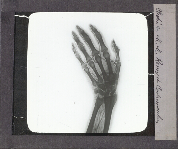 X-Ray photograph of human hand