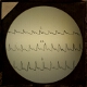 [Diagram of heart rhythm]