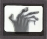X-Ray photograph of human hand with severely deformed fingers – Rear view of slide