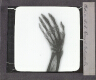 X-Ray photograph of human hand – Rear view of slide