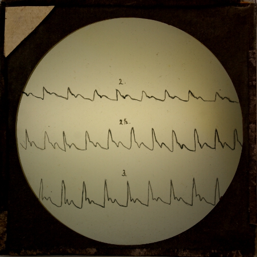 Diagram of heart rhythm