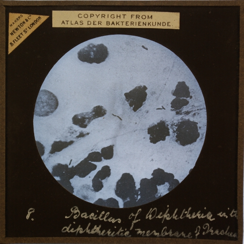 Bacillus of Diphtheria in the diphtheritic membrane from the Trachea