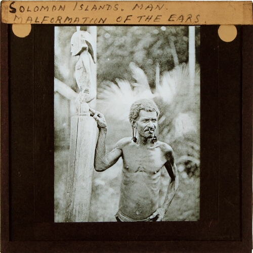 Solomon Islands Man -- Malformation of Ears