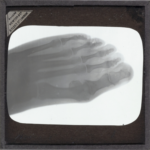 Foot of man (Gout)