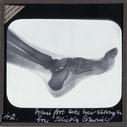 Man’s foot, side view, showing ankle bones
