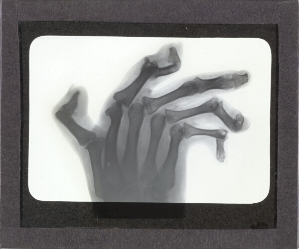 X-Ray photograph of human hand with severely deformed fingers