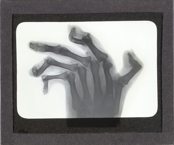 X-Ray photograph of human hand with severely deformed fingers – secondary view of slide