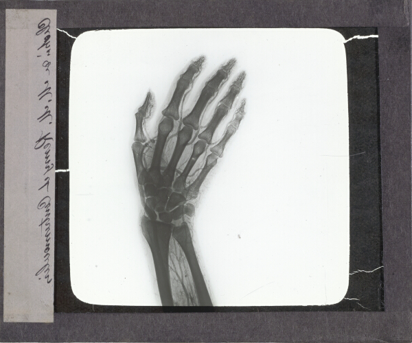 X-Ray photograph of human hand – secondary view of slide