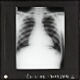 [X-Ray photograph of human chest]