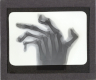 X-Ray photograph of human hand with severely deformed fingers – Image inverted to correct view