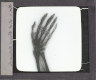 X-Ray photograph of human hand – Image inverted to correct view